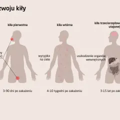 Ilustracja pokazuje stadia rozwoju kiły: pierwotna (wrzód), wtórna (wysypka) i trzeciorzędowa (uszkodzenie organów).