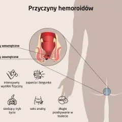 Ilustracja pokazuje, jak wyglądają hemoroidy wewnętrzne i zewnętrzne, oraz wymienia ich przyczyny: ciąża, wysiłek fizyczny, zaparcia, biegunka, dieta, siedzący tryb życia, seks analny, długie przebywanie w toalecie.