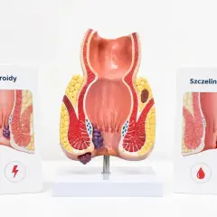 Model anatomiczny przedstawia hemoroidy i szczelinę odbytu, ukazując objawy tych schorzeń.