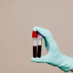 Rękawiczka medyczna trzyma probówki z ciemną cieczą, sugerującą krew w moczu u kobiety.