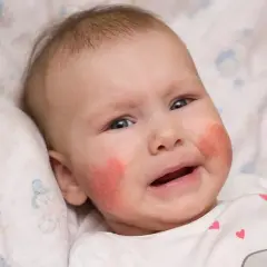 Czerwone policzki u niemowlaka mogą być oznaką skazy białkowej. Jak rozpoznać to schorzenie u maluszka?