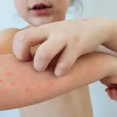 Dziecko drapie swędzącą skórę z krostkami, objawem **ospy wietrznej u dzieci**.