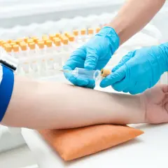 Pobieranie krwi do analizy gazometrycznej. To badanie ocenia poziom tlenu i dwutlenku węgla we krwi.