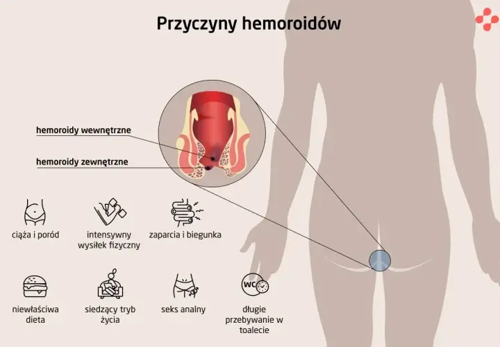Ilustracja pokazuje, jak wyglądają hemoroidy wewnętrzne i zewnętrzne, oraz wymienia ich przyczyny: ciąża, wysiłek fizyczny, zaparcia, biegunka, dieta, siedzący tryb życia, seks analny, długie przebywanie w toalecie.