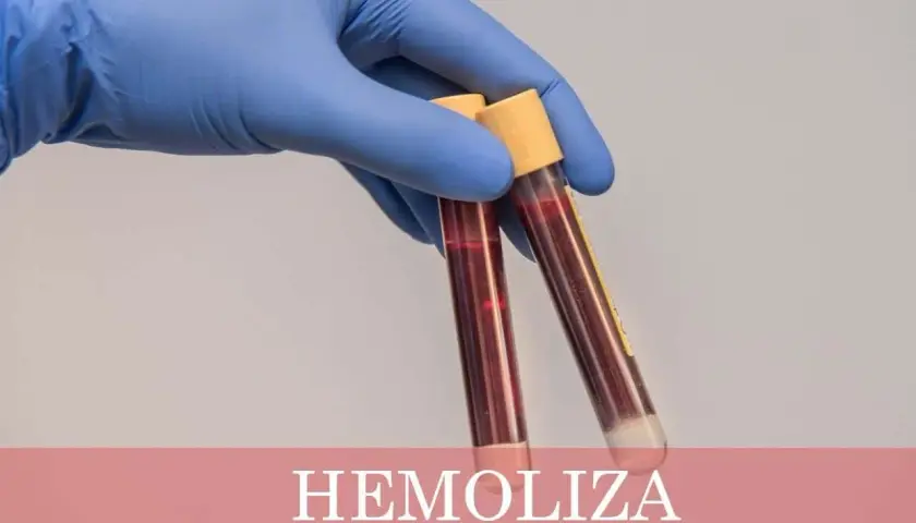 Ręka w niebieskiej rękawiczce trzyma probówki z krwią. Na dole widnieje napis "HEMOLIZA CO TO", wyjaśniający zjawisko rozpadu czerwonych krwinek.