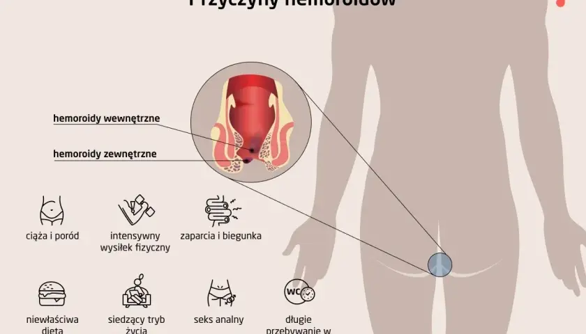 Ilustracja pokazuje, jak wyglądają hemoroidy wewnętrzne i zewnętrzne, oraz wymienia ich przyczyny: ciąża, wysiłek fizyczny, zaparcia, biegunka, dieta, siedzący tryb życia, seks analny, długie przebywanie w toalecie.
