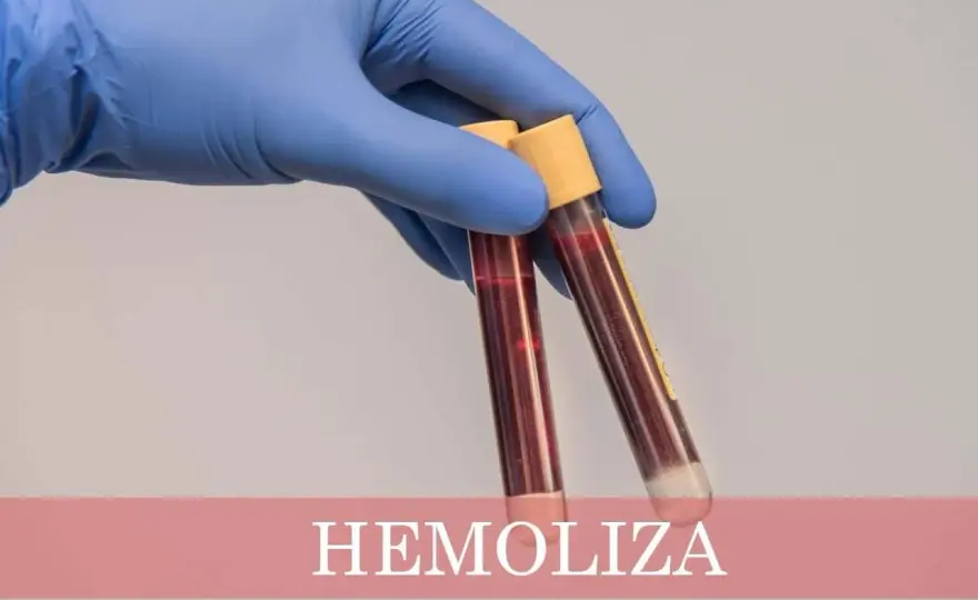 Hemoliza - co oznacza i jakie badania warto wykonać?