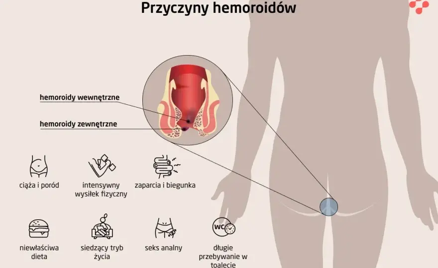 Jak wyglądają hemoroidy i kiedy wymagają badania?
