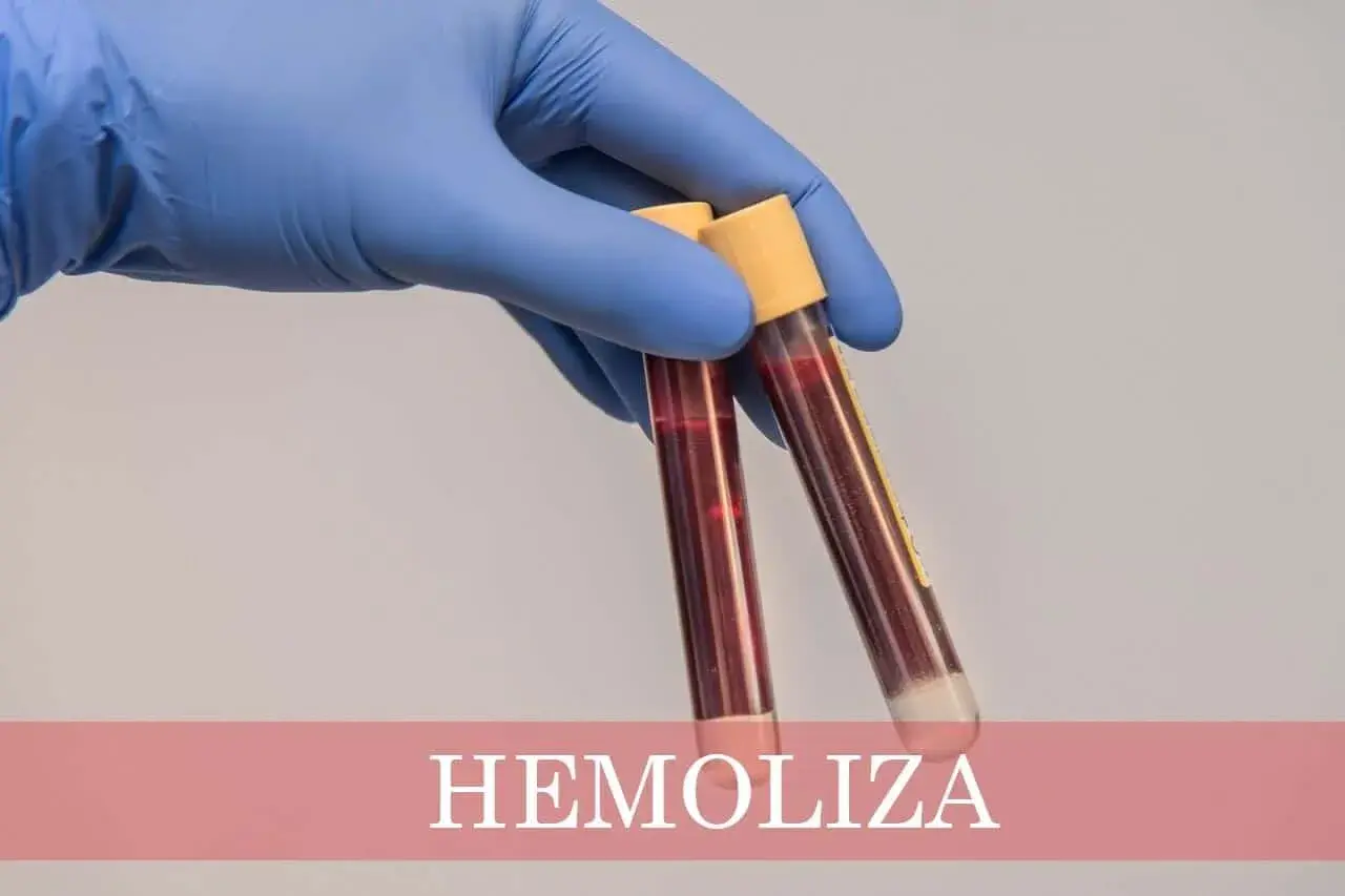 Ręka w niebieskiej rękawiczce trzyma probówki z krwią. Na dole widnieje napis "HEMOLIZA CO TO", wyjaśniający zjawisko rozpadu czerwonych krwinek.