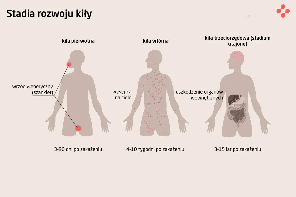 Ilustracja pokazuje stadia rozwoju kiły: pierwotna (wrzód), wtórna (wysypka) i trzeciorzędowa (uszkodzenie organów).