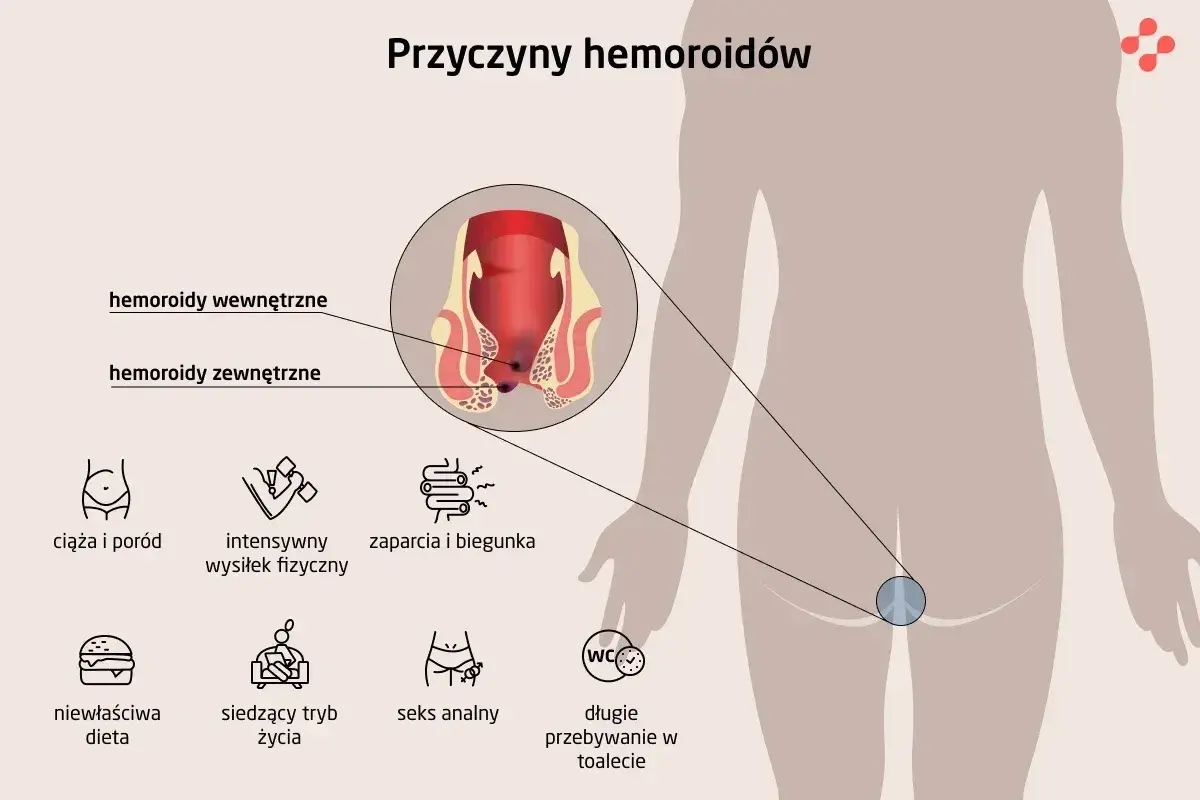 Ilustracja pokazuje, jak wyglądają hemoroidy wewnętrzne i zewnętrzne, oraz wymienia ich przyczyny: ciąża, wysiłek fizyczny, zaparcia, biegunka, dieta, siedzący tryb życia, seks analny, długie przebywanie w toalecie.