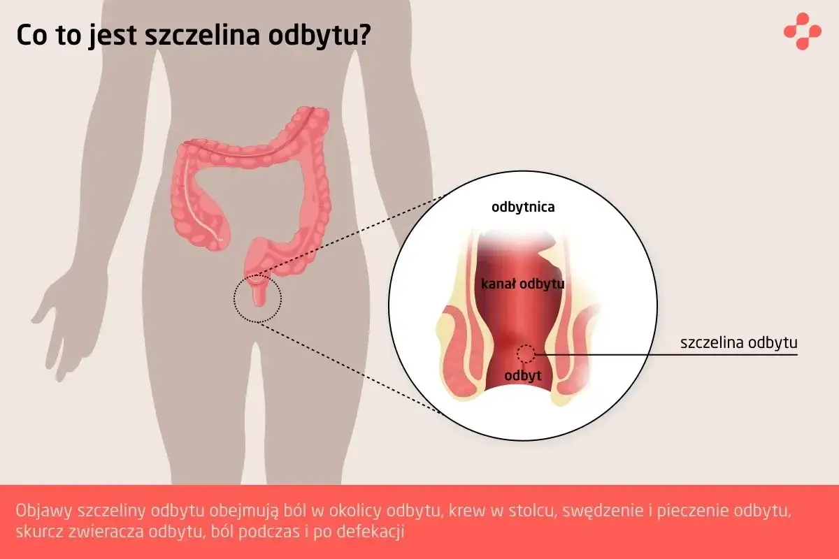 Ilustracja pokazuje anatomię odbytu z zaznaczoną szczeliną. Objawy szczeliny odbytu to b&oacute;l, krwawienie i pieczenie.