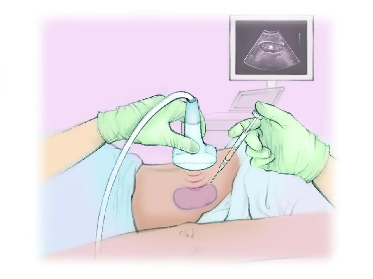 Lekarz wykonuje biopsję tarczycy pod kontrolą USG, pobierając próbkę tkanki do analizy.